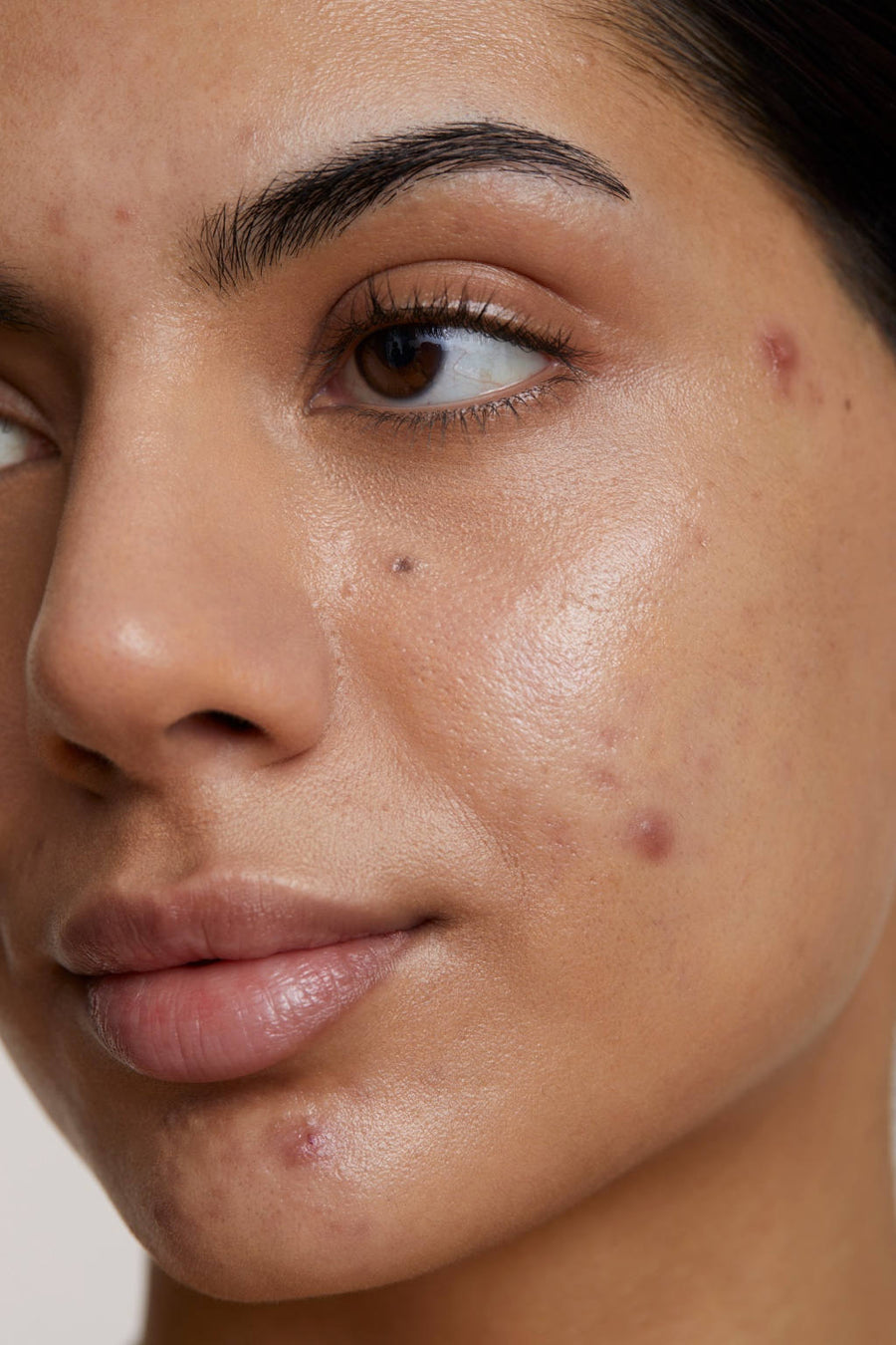 Acné e imperfecciones