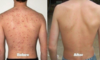 Body Acne Oil