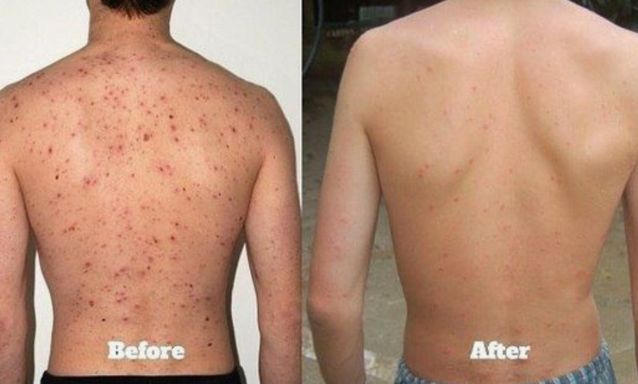 Body Acne Oil